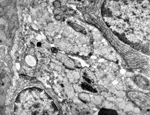 jejunum … lipid malabsorption jejunum … lipid malabsorption